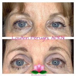 DermAesthetics - Fractora and Morpheus8 skin tightening for face and body