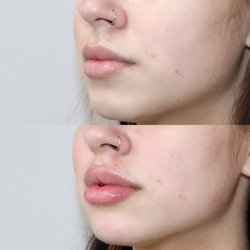 La Belle Vie MedSpa - Lip Filler
