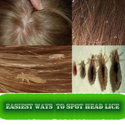 Pickem Lice Removal - Lice and nits.