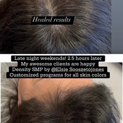 SMP Hair Clinic The Queen Of Scalp - Density SMP. Healed results & after no 2. Specialize in all skin tone types. Client: Female Asian.