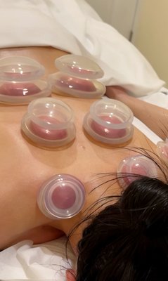 Cupping - Photos of cupping my clients! Cupping - Photos of cupping my clients!