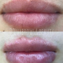 D’LuxBrows & Beauty - Needle-Less Lip Filler