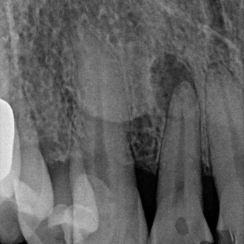 Boca Park Dental - Tooth 10, the next to my front teeth. - General Dentistry Near Me - Las Vegas, Nevada Boca Park Dental - Tooth 10, the next to my front teeth. - General Dentistry Near Me - Las Vegas, Nevada