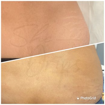 She Drips - Stretch mark camouflage of the flanks. - Permanent Makeup Near Me - Raleigh, North Carolina She Drips - Stretch mark camouflage of the flanks. - Permanent Makeup Near Me - Raleigh, North Carolina