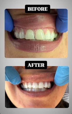 Dental Crowns - Don't Accept Denti-Cal & HMO Ins. Accept all PPO Ins. At Oxnard Dental Office, we understand the importance of having a dental practice that provides you with exceptional care. Our staff is committed to serving each and every patient with attentive care and impeccable dental work. As one of our patients, you deserve nothing less. Our practice provides general dentistry services including the prevention, diagnosis, and treatment of a wide variety of conditions and diseases that affect your teeth, gums, and oral health. At Oxnard Dental Office, we are committed to ensuring your oral health is in excellent condition. We make this possible by attending to all dental issues, existing and potential, during your visit. Dental Crowns - Don't Accept Denti-Cal & HMO Ins. Accept all PPO Ins. At Oxnard Dental Office, we understand the importance of having a dental practice that provides you with exceptional care. Our staff is committed to serving each and every patient with attentive care and impeccable dental work. As one of our patients, you deserve nothing less. Our practice provides general dentistry services including the prevention, diagnosis, and treatment of a wide variety of conditions and diseases that affect your teeth, gums, and oral health. At Oxnard Dental Office, we are committed to ensuring your oral health is in excellent condition. We make this possible by attending to all dental issues, existing and potential, during your visit.