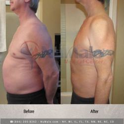 NuMale Medical Center - Medical Weight Loss for Men. Before and After