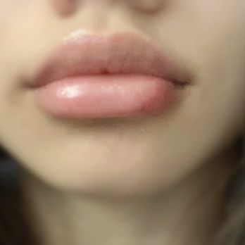 Alani Skin MD - 2 weeks after - Skin Care Near Me - Mesa, Arizona Alani Skin MD - 2 weeks after - Skin Care Near Me - Mesa, Arizona