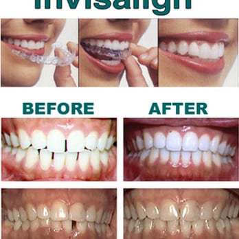 Family Dentistry - We are your Best choice for Invisalign! - General Dentistry Near Me - Sterling Heights, Michigan Family Dentistry - We are your Best choice for Invisalign! - General Dentistry Near Me - Sterling Heights, Michigan