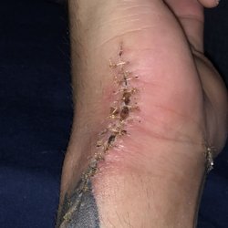 Florida Center for Plastic and Cosmetic Surgery - Soon after stitches, still healing.
