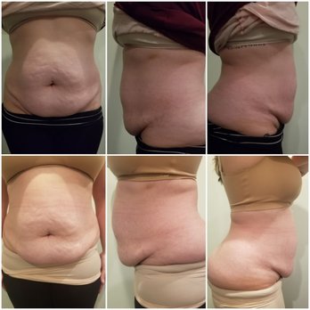 Esthetics By Bev - Before & After Body Sculpting pics - Skin Care Near Me - Berlin, Connecticut