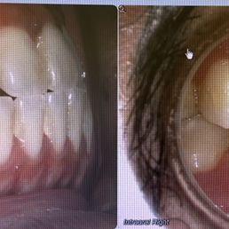 Left Photo - before braces
Right Photo - after braces Left Photo - before braces
Right Photo - after braces