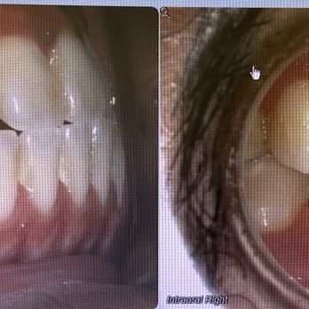 San Marcos Orthodontics - Left Photo - before braces
Right Photo - after braces - Orthodontists Near Me - San Marcos, California San Marcos Orthodontics - Left Photo - before braces
Right Photo - after braces - Orthodontists Near Me - San Marcos, California