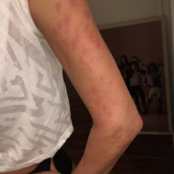Celebrity Looks Laser Clinic - Laser burn marks all over my left arm.