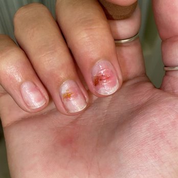 Essence Nails & Spa - This is 2 days later and they are still extremely painful - Nail Salons Near Me - Salisbury, Massachusetts Essence Nails & Spa - This is 2 days later and they are still extremely painful - Nail Salons Near Me - Salisbury, Massachusetts