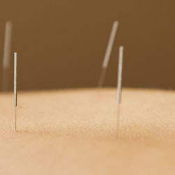 Acupuncture for All