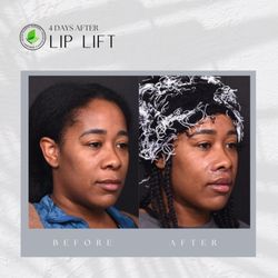 Aviva Plastic Surgery & Aesthetics - Liplift surgery for facial balancing and improving the smile