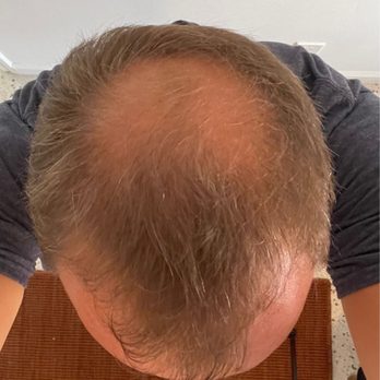 Cassia Cardoso - October 2022 - Before hair PRP treatments and the preceding FUE transplant. - Skin Care Near Me - Ft Lauderdale, Florida Cassia Cardoso - October 2022 - Before hair PRP treatments and the preceding FUE transplant. - Skin Care Near Me - Ft Lauderdale, Florida