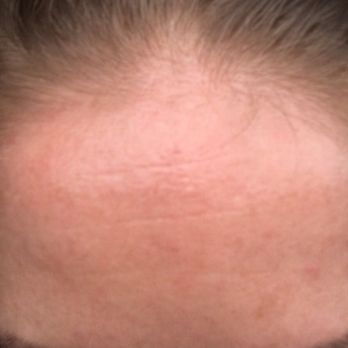 Rejuvenate Austin - Wrinkles are still there - Skin Care Near Me - Austin, Texas Rejuvenate Austin - Wrinkles are still there - Skin Care Near Me - Austin, Texas