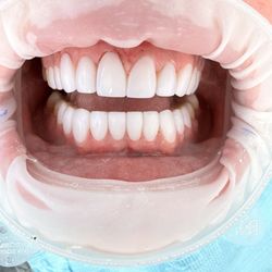 Hollywood Perfect Smile - Resin veneers with gum contouring
