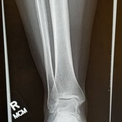 Penn Highlands Fracture Clinic - My broken ankle is finally healing