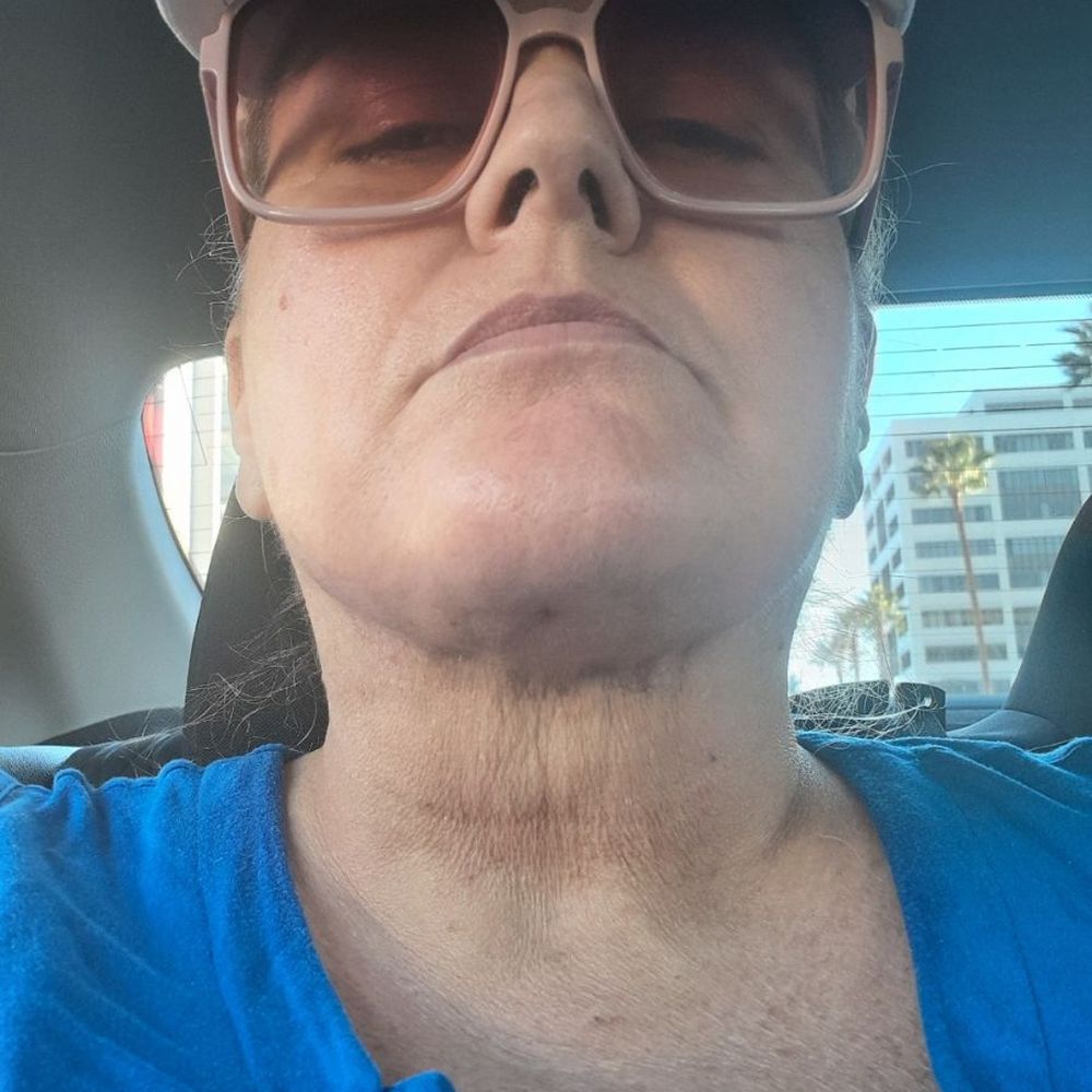Venus MD - 2 hours after lymphatic massage day 1 neck like 80 year old skin - Laser Hair Removal Near Me - Huntington Beach, California Venus MD - 2 hours after lymphatic massage day 1 neck like 80 year old skin - Laser Hair Removal Near Me - Huntington Beach, California