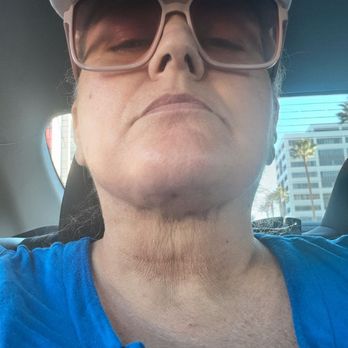 Venus MD - 2 hours after lymphatic massage day 1 neck like 80 year old skin - Laser Hair Removal Near Me - Huntington Beach, California Venus MD - 2 hours after lymphatic massage day 1 neck like 80 year old skin - Laser Hair Removal Near Me - Huntington Beach, California