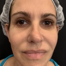 Aesthetic Pearl - Skin tightening on the Right side of the face - see an immediate lift compared to the Left with no surgery or downtime.