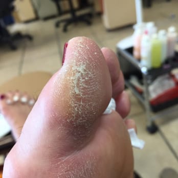 Elite Nails - This callous looked better before the pedicure! - Nail Salons Near Me - Lake Havasu City, Arizona