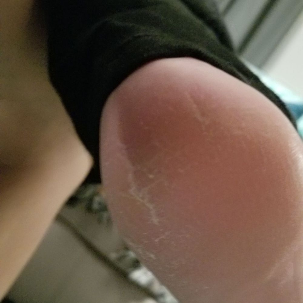 My "just fine" heels according to the technician. My "just fine" heels according to the technician.