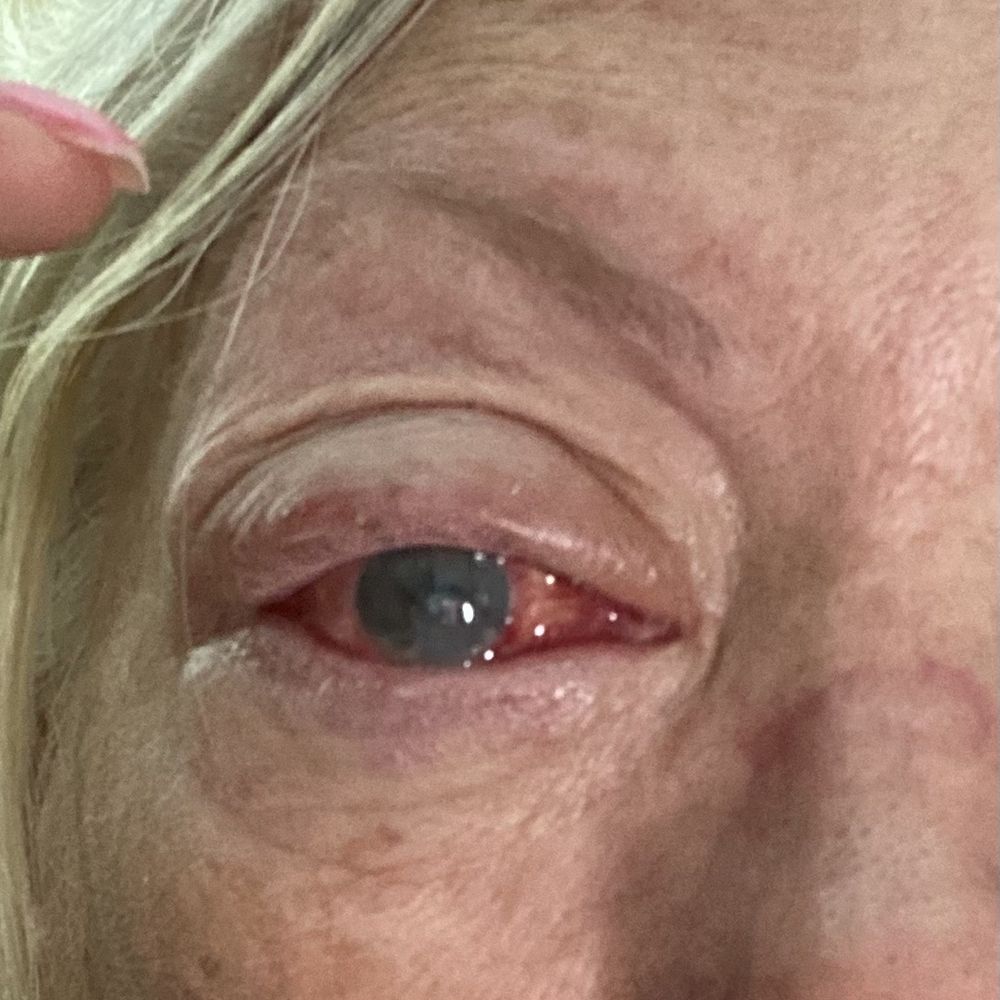 Target Optical - Corneal ulcer - Eyewear & Opticians Near Me - Fort Myers, Florida Target Optical - Corneal ulcer - Eyewear & Opticians Near Me - Fort Myers, Florida