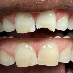 Peach Smiles - Chipped tooth filling