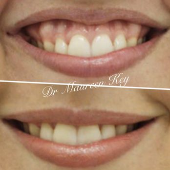 New Look Solutions - "Gummy smile" treated with just 4 units of Botox. If you are unhappy with your smile showing a lot of your gums- give us a call. - Weight Loss Centers Near Me - Pueblo, Colorado New Look Solutions - "Gummy smile" treated with just 4 units of Botox. If you are unhappy with your smile showing a lot of your gums- give us a call. - Weight Loss Centers Near Me - Pueblo, Colorado