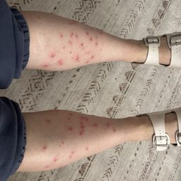 Cellulitis and folliculitis Cellulitis and folliculitis