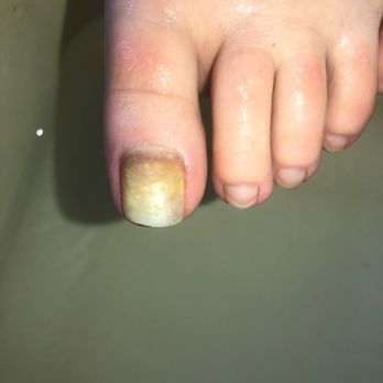 Glamorous Nails - Toe nail fungus - Nail Salons Near Me - Gainesville, Florida Glamorous Nails - Toe nail fungus - Nail Salons Near Me - Gainesville, Florida