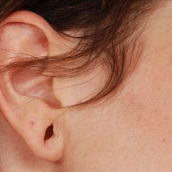 Struong Cosmetic - Ear Lobes Repair - Cosmetic Surgeons Near Me - Westminster, California