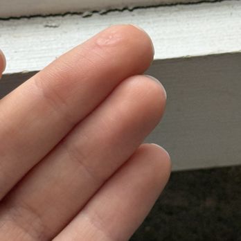 Boston's Nails & Spa - Contact dermatitis scarring - Waxing Near Me - Boston, Massachusetts