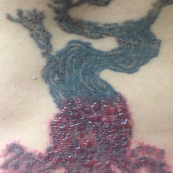 Removery Tattoo Removal & Fading - Result of first session of laser removal, the next day - Tattoo Removal Near Me - San Diego, California