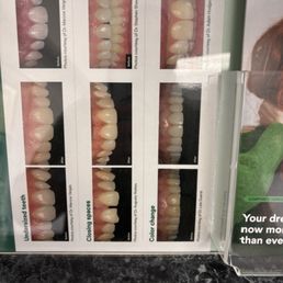 Teeth cleaning Teeth cleaning