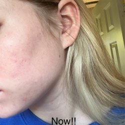 Image Spa MD - This is after I started seeing Kaitlyn!! Like i said, she listens to my needs and is so so helpfu.