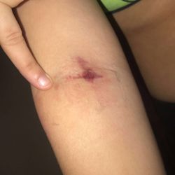 CHI Saint Joseph Health - Saint Joseph Mount Sterling - This was the cause of the nurse ripping the IV out busting another vein. My finger was point of entry she was very aggressive towards me.