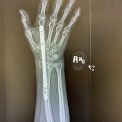 Atlantic Orthopaedic Specialists - Virginia Beach - NO CAST NEEDED!!! TITANIUM PLATE SCREWED INTO FINGER AND WRIST TO "STABILIZE" BROKEN WRIST