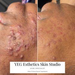 YEG Esthetics Skin Studio