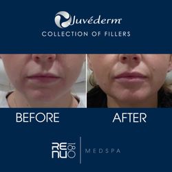 Re:nu 180 Medspa - #Juvederm Results!