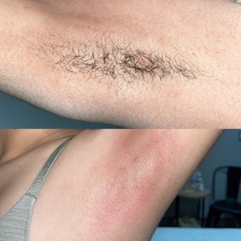 Pampered by Katz - Summer time fine! Ditch the razor this summer and let your underarms look cleaner and lighter with hairs growing back thinner! - Skin Care Near Me - Denver, Colorado Pampered by Katz - Summer time fine! Ditch the razor this summer and let your underarms look cleaner and lighter with hairs growing back thinner! - Skin Care Near Me - Denver, Colorado