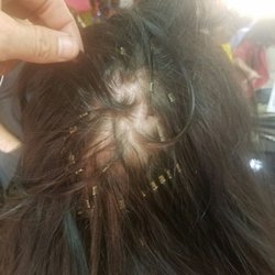 Damage from misplaced hair extensions at mane st junction showing hair loss