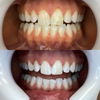 We Whiten - Before & After - The images display a set of teeth in a before-and-after format, with the top image showing teeth prior to whitening, exhibiting yellowish coloration and unevenness. The bottom image shows the same teeth after whitening, appearing significantly brighter and more uniform. Both images focus on the mouth open wide, with a dental retractor in place to expose the teeth clearly. The photos are taken in a clinical setting, emphasizing dental cosmetic improvements. - Teeth Whitening Near Me - Tempe, Arizona
