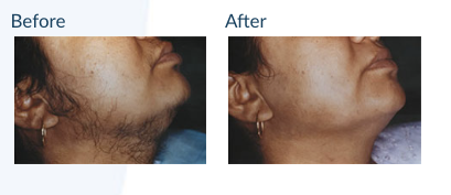 Laser Hair Removal - Shaving, tweezing and waxing can be such a constant chore and often painful. If you’re tired of the tedium of these hair removal techniques but still want smooth, silky skin, then laser hair removal is right for you. Laser hair removal has gained much popularity over the past few years with both men and women because of its effective results that are both safe and gentle. And with no patient recovery time needed, treatments can easily fit in a busy lifestyle.

At Laser Esthetica, we have a variety of state-of-the-art lasers to meet different hair removal needs. Dr. Prasad and her team are laser hair removal specialists, performing treatments since the opening of Laser Esthetica in 2001. They understand the differences in skin and hair texture as well as condition to determine what medical equipment will achieve the best results.