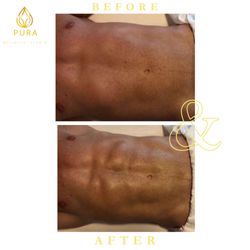 Full body Brazilian lymphatic drainage massage