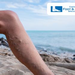 Varicose veins and spider veins
