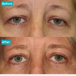 Eyesthetica - This patient underwent a ptosis procedure to restore both function and aesthetic balance to the eyes.